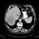 Hepatocellular carcinoma, bleeding after biopsy: CT - Computed tomography